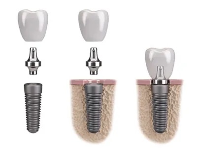 Implant Crowns